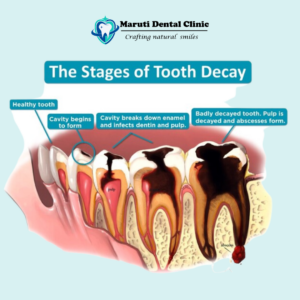 stages of tooth decay treatment