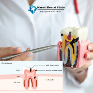 tooth decay treatment