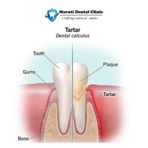 Plaque in Teeth