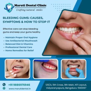 Bleeding gums