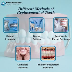 difference method of replacement of tooth