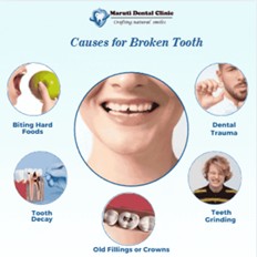 Causes of broken tooth