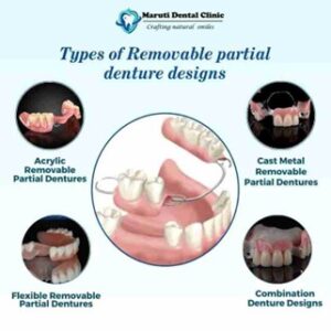 types of removable partial denture designs