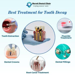 Treatment for Tooth Decay
