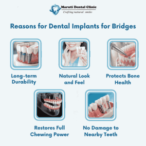 Implant supported Bridges