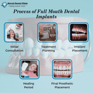full mouth dental implants