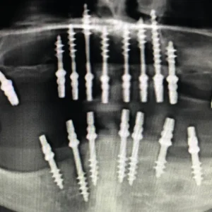 Cortico-Basal-Implants-Immediate-implants