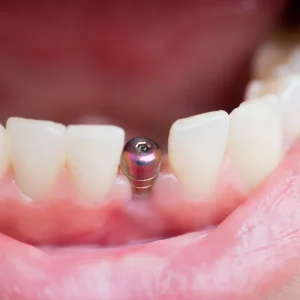 Dental-Implants