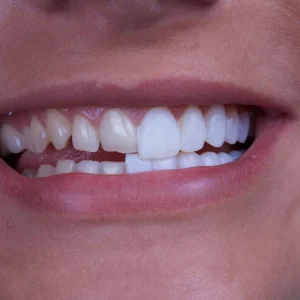 Dental-Veneers-scaled