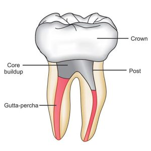 Post & core restoration