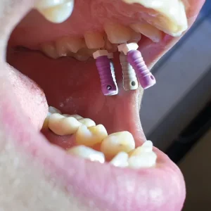 Root Canal Treatment