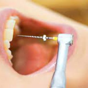 Rotary endodontic