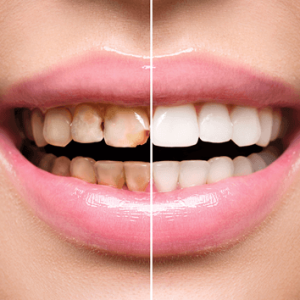 Scaling-and-polishing