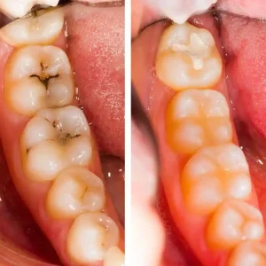 Treatment for Tooth Decay at Maruti Dental