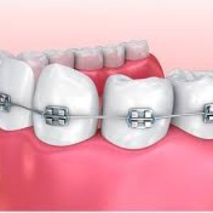 braces