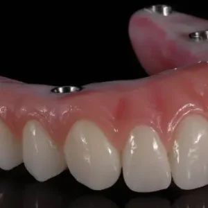 fixed-complete-denture