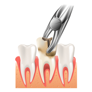 tooth extraction1