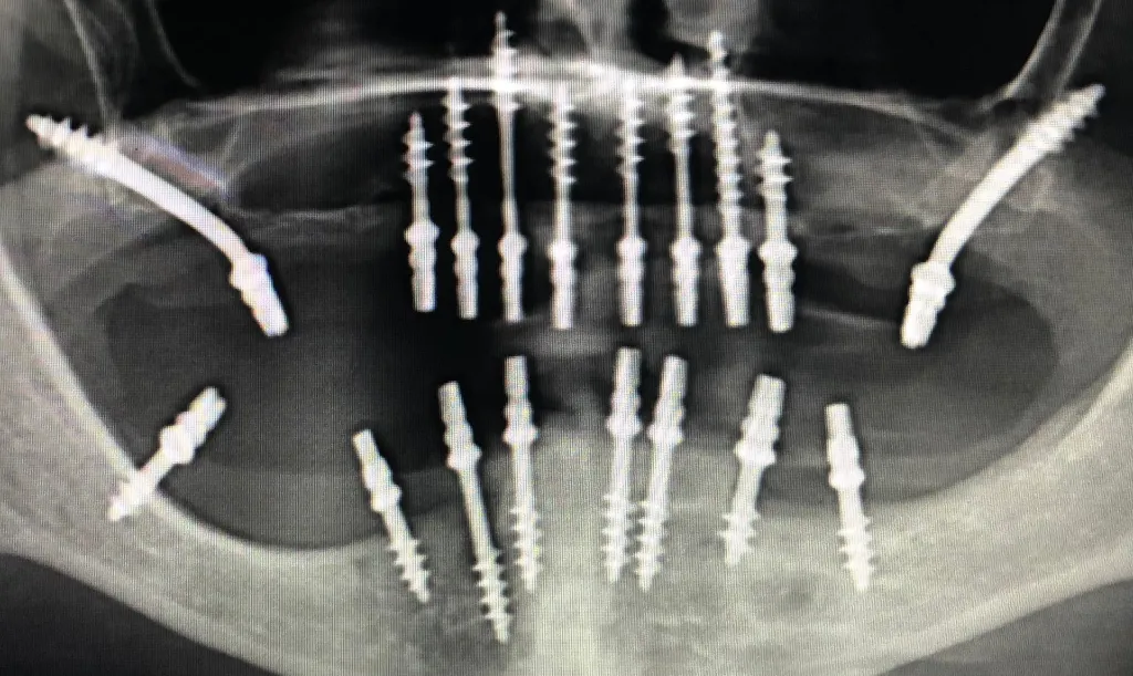 Cortico-Basal-Implants-Immediate-implants Cortico-Basal-Implants-Immediate-implants