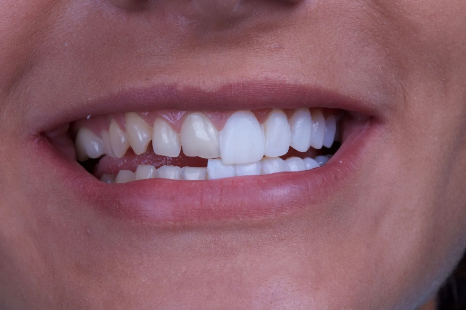Dental-Veneers-scaled Dental-Veneers-scaled
