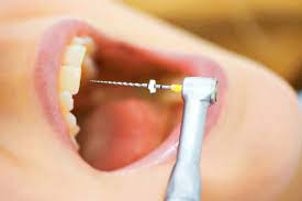 Rotary endodontic Rotary endodontic