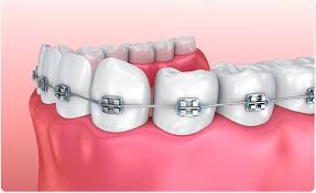 braces braces