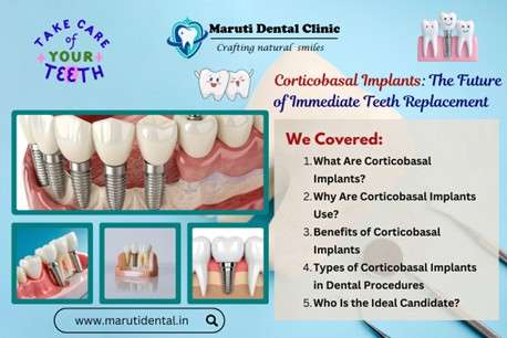 Corticobasal Implants: The Future of Immediate Teeth Replacement