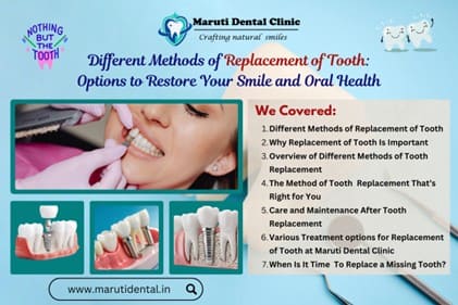 Replacement of Tooth: Best Methods to Restore Your Smile