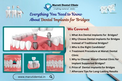 Everything You Need to Know About Implant supported Bridges