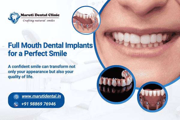 Full Mouth Dental Implants for a Perfect Smile