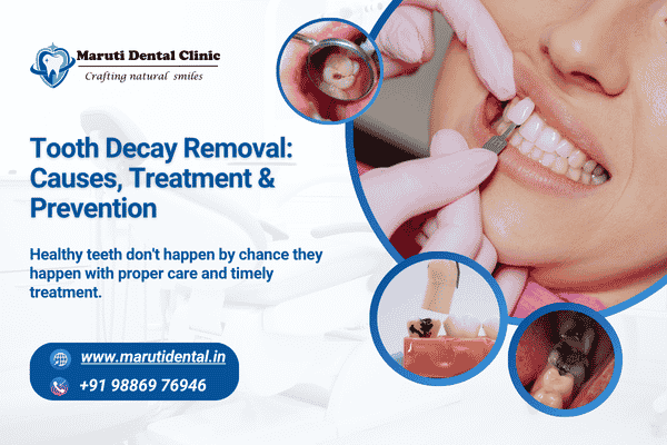 Tooth Decay: Causes, Treatment & Prevention